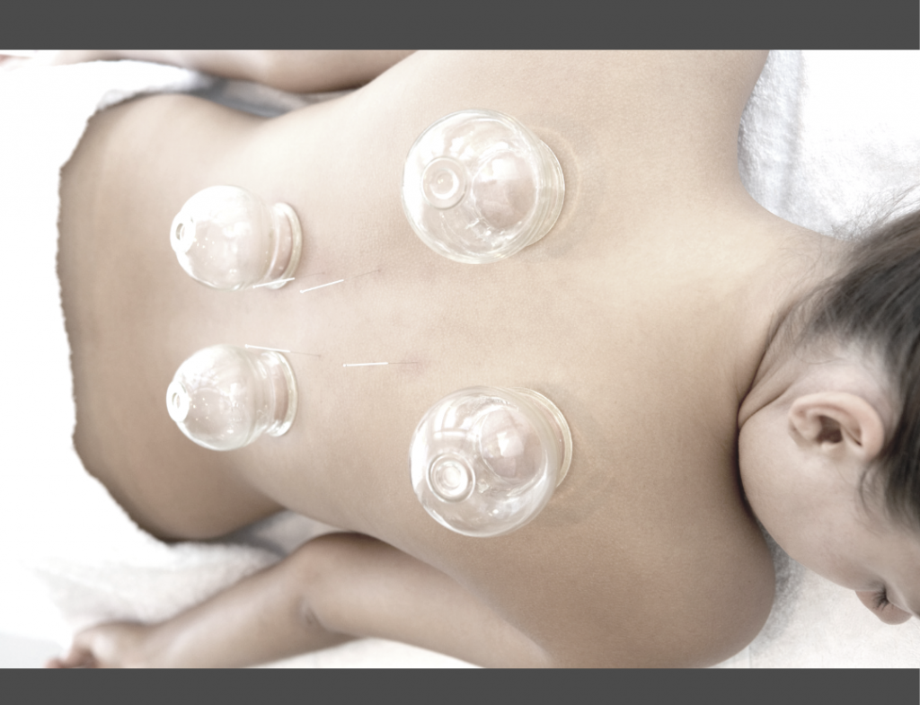 What is Cupping? And why is it good for you?